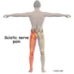 sciatic-nerve-pain