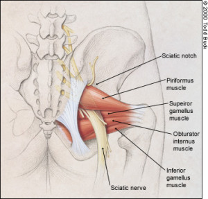 piriformis-syndrome