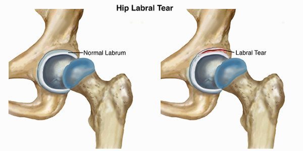 FAI hip labral tear