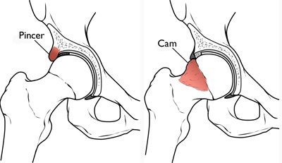 FAI hip labral tear types