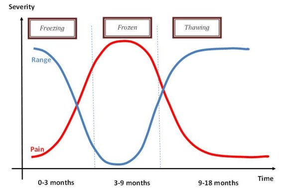 Frozen Shoulder: Does It Really Thaw? | Duncan Sports Therapy + Wellness